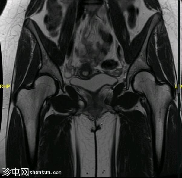 坐骨股骨撞击症