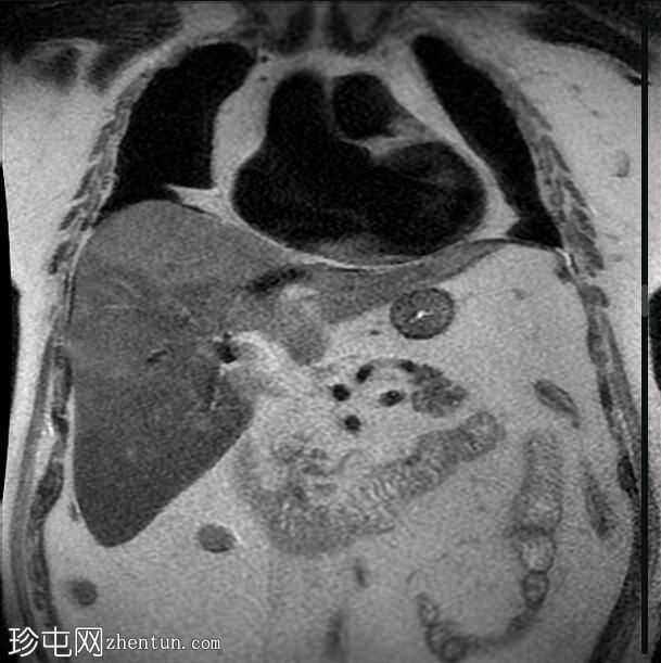 结节性和地图样肝脂肪变性