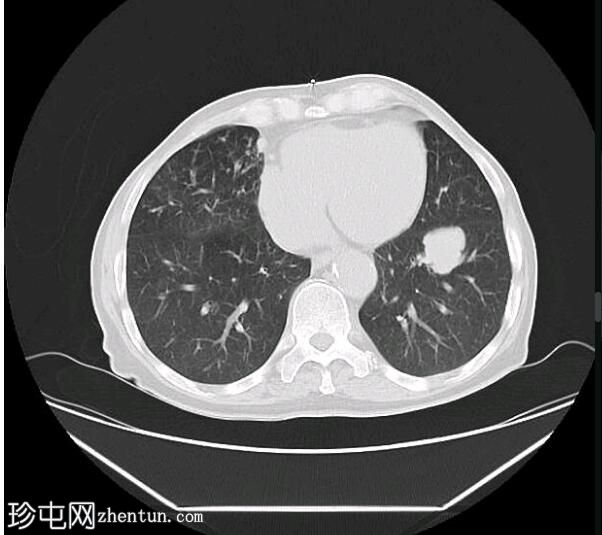 CT 引导下胸部活检 - 左肺肿块