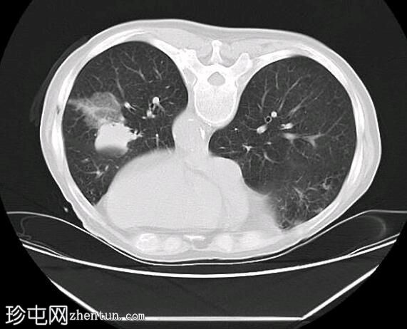 CT 引导下胸部活检 - 左肺肿块