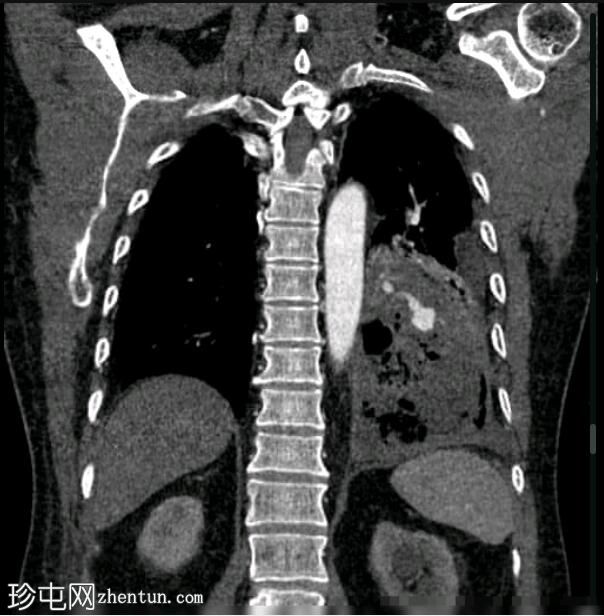 肺动脉假性动脉瘤