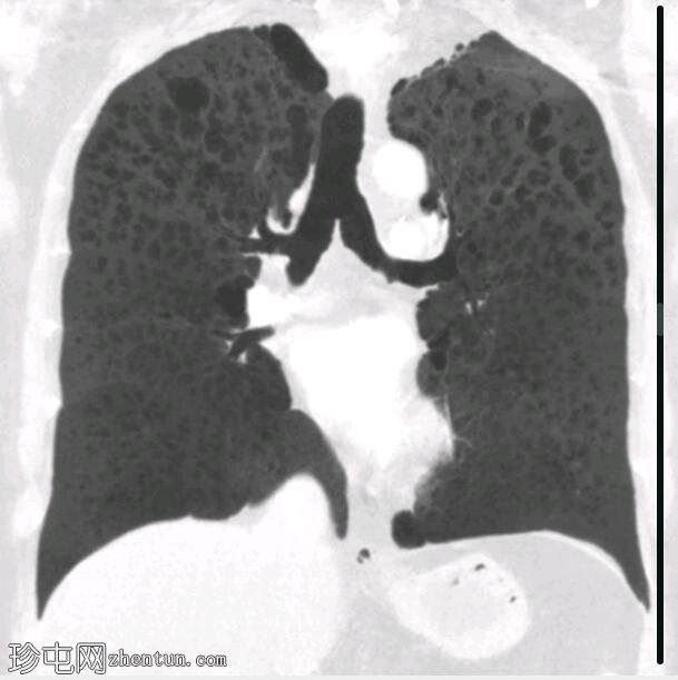 肺朗格汉斯细胞组织细胞增生症