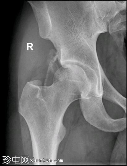 亚急性髂前下棘撕脱骨折