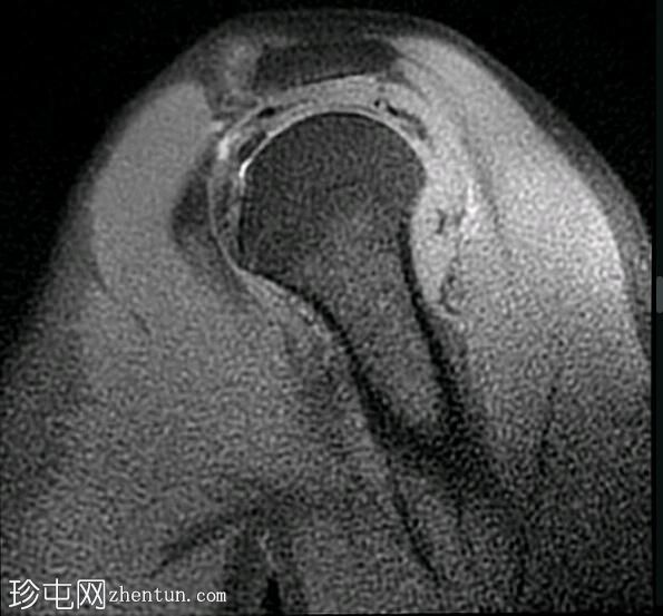 钙化性肌腱炎 - 冈上肌和冈下肌