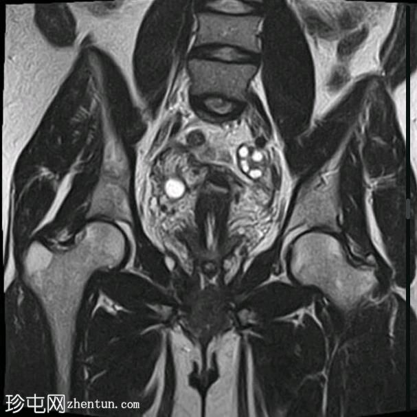 剖腹产疤痕峡部膨出