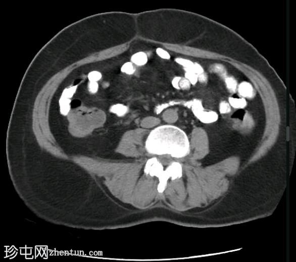 深部盆腔子宫内膜异位症（MRI）