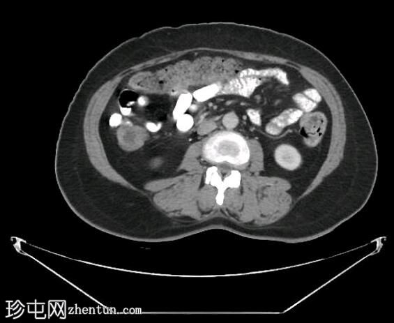 深部盆腔子宫内膜异位症（MRI）