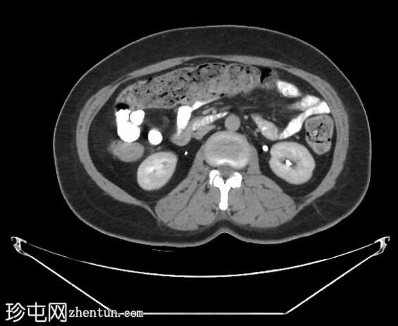 深部盆腔子宫内膜异位症（MRI）