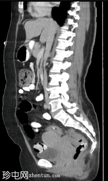 深部盆腔子宫内膜异位症（MRI）