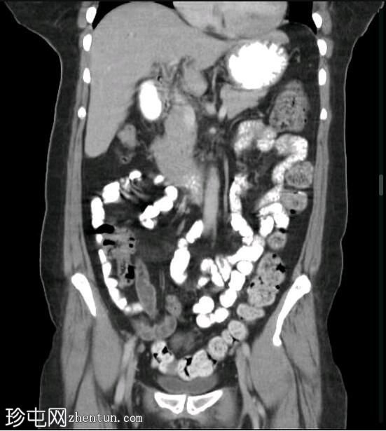 深部盆腔子宫内膜异位症（MRI）