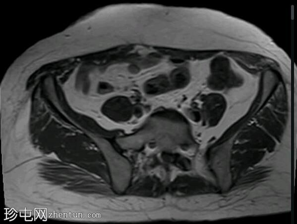 深部盆腔子宫内膜异位症（MRI）