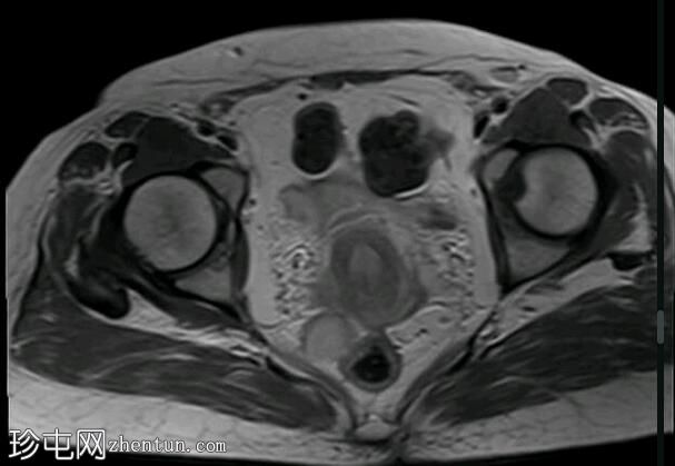 深部盆腔子宫内膜异位症（MRI）