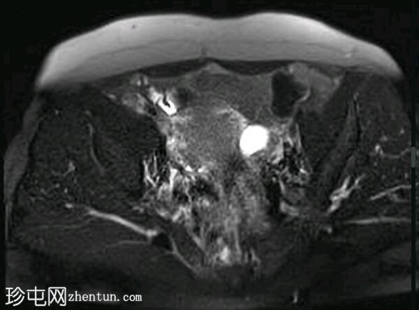 深部盆腔子宫内膜异位症（MRI）