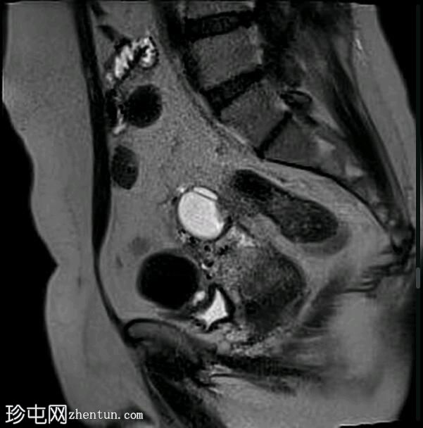 深部盆腔子宫内膜异位症（MRI）