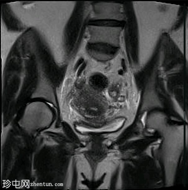 深部盆腔子宫内膜异位症（MRI）