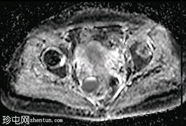 深部盆腔子宫内膜异位症（MRI）