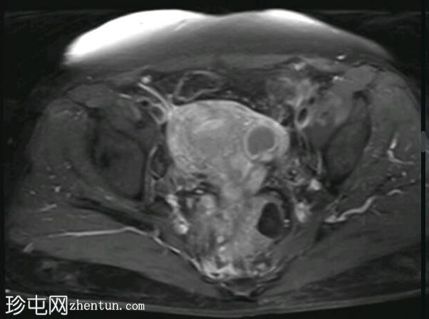 深部盆腔子宫内膜异位症（MRI）