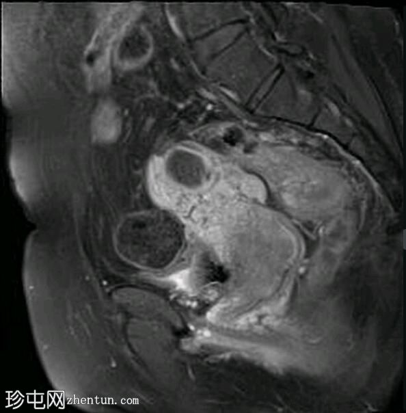 深部盆腔子宫内膜异位症（MRI）