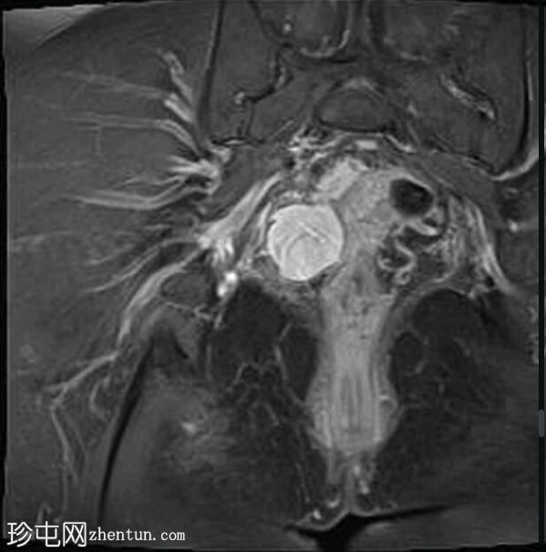 深部盆腔子宫内膜异位症（MRI）