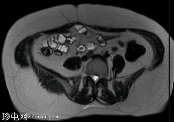 深部盆腔子宫内膜异位症（MRI）