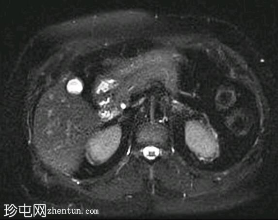 深部盆腔子宫内膜异位症（MRI）