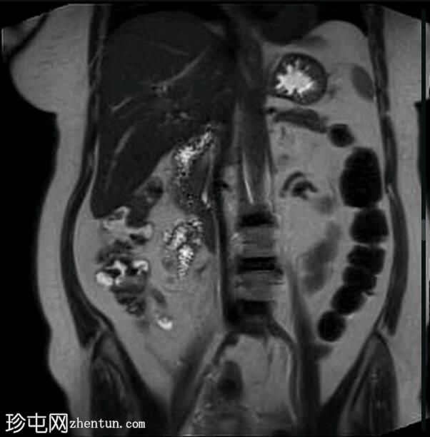 深部盆腔子宫内膜异位症（MRI）