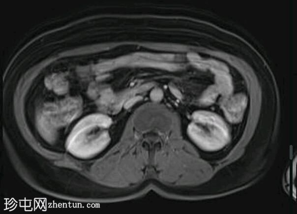 深部盆腔子宫内膜异位症（MRI）