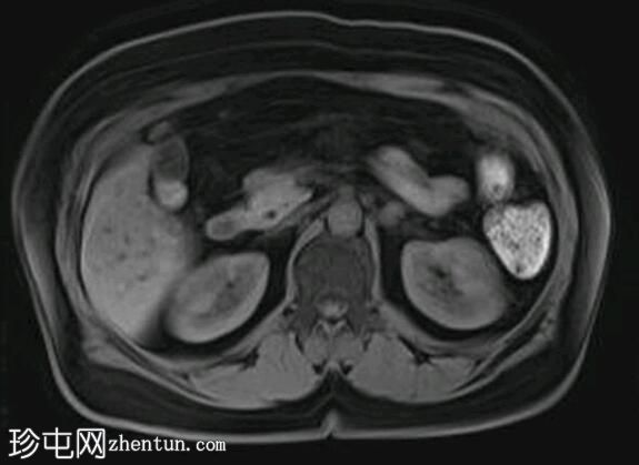 深部盆腔子宫内膜异位症（MRI）