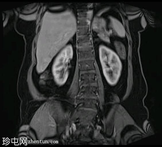 深部盆腔子宫内膜异位症（MRI）