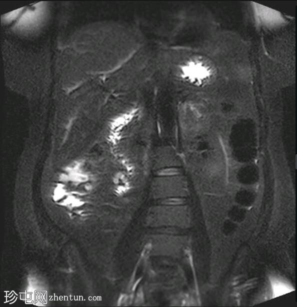 深部盆腔子宫内膜异位症（MRI）