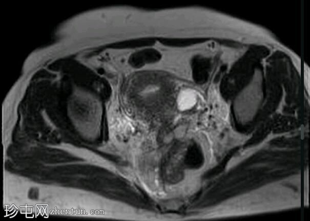 深部盆腔子宫内膜异位症（MRI）