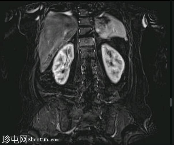 深部盆腔子宫内膜异位症（MRI）