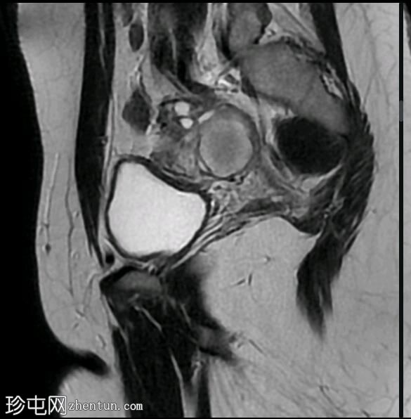 出血性黄体囊肿