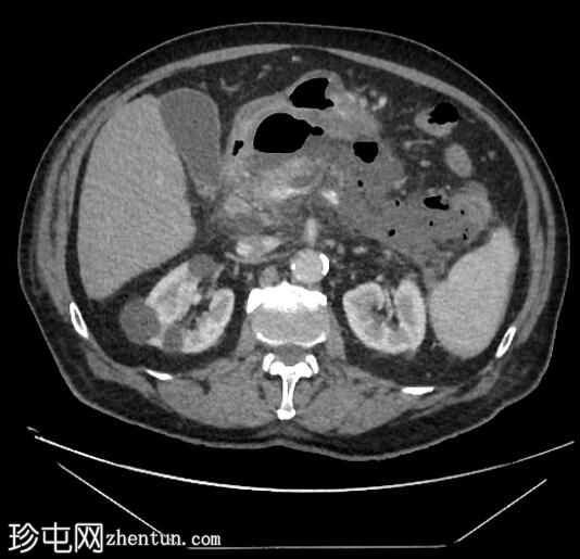 坏死性胰腺炎伴结肠穿孔