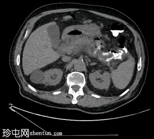 坏死性胰腺炎伴结肠穿孔