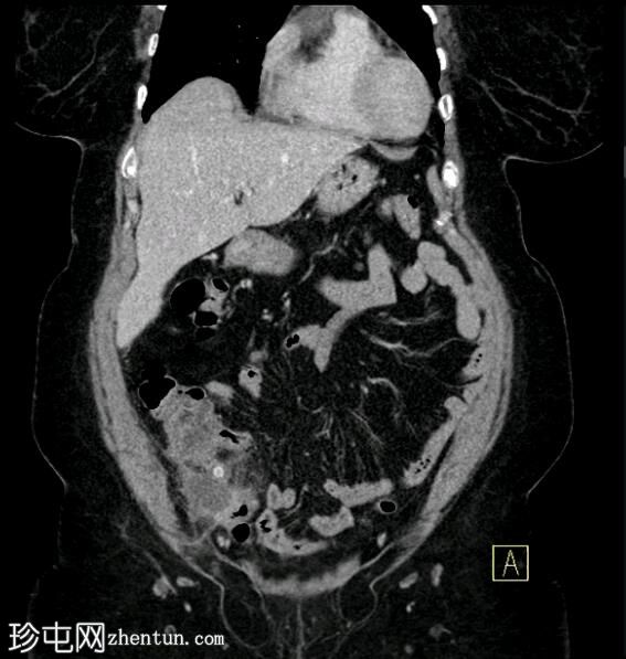 急性阑尾炎并发脓肿