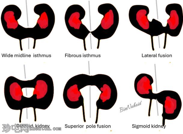 纤维峡部形态的马蹄肾
