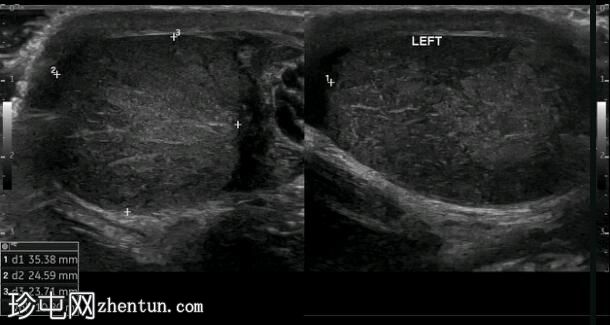 睾丸扭转（7小时超声检查）