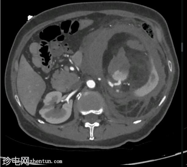 出血性肾血管平滑肌脂肪瘤