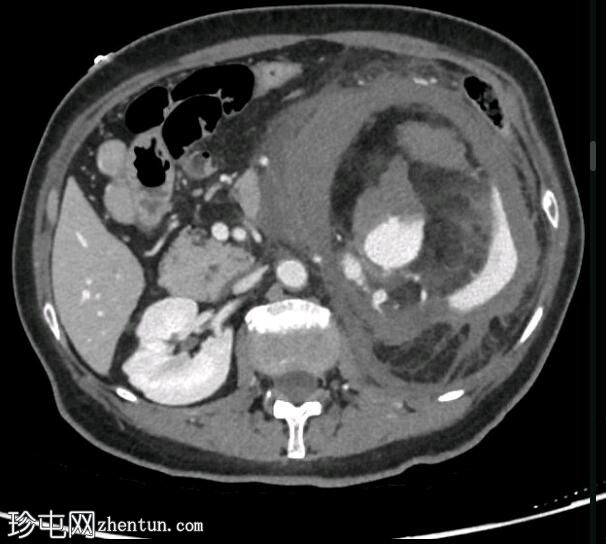 出血性肾血管平滑肌脂肪瘤