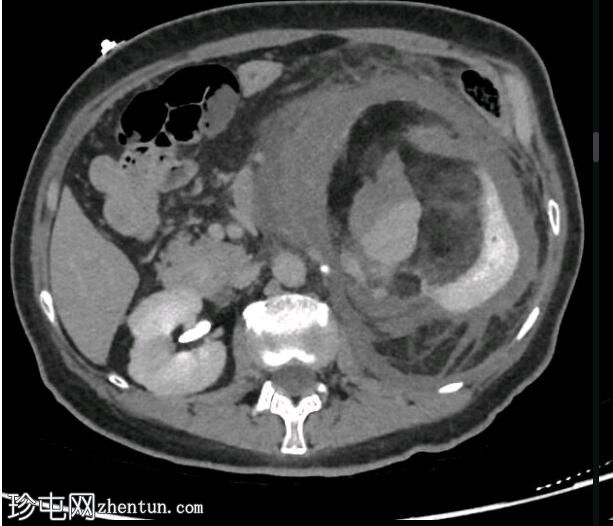 出血性肾血管平滑肌脂肪瘤