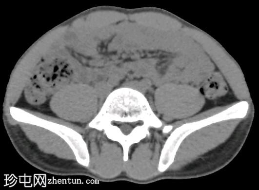 CT腹部平片检查正常