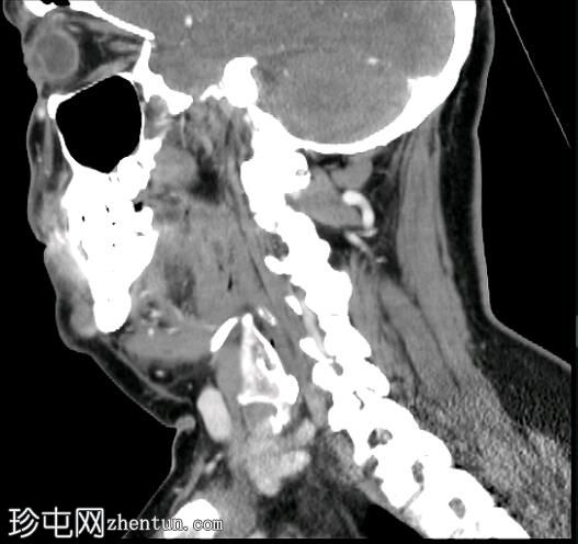 碘化腮腺炎