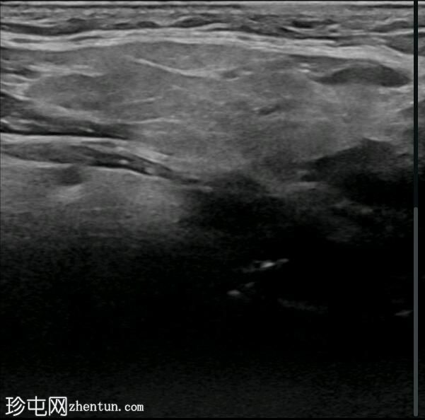 碘化腮腺炎