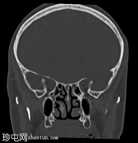 纤维发育不良