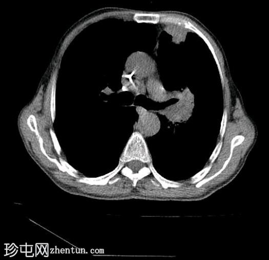 肺鳞状细胞癌