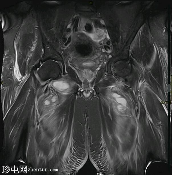 耻骨联合化脓性关节炎和骨髓炎