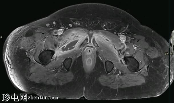 耻骨联合化脓性关节炎和骨髓炎