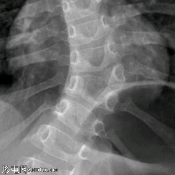 先天性脊柱侧弯 - 楔形、半节段和节段半椎骨