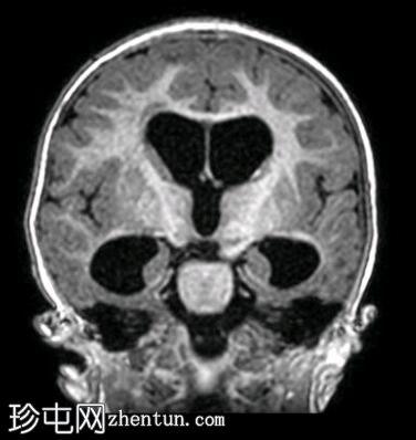 导水管狭窄